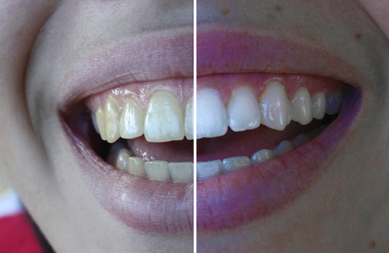 How to whiten teeth | photoshop tutorial