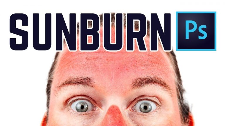 How to Get Rid of Sunburn (almost) Instantly!