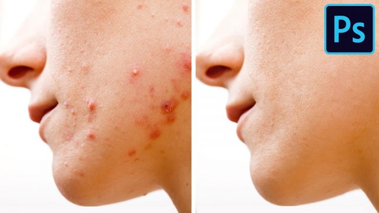 5 Ways to Remove Pimples FAST